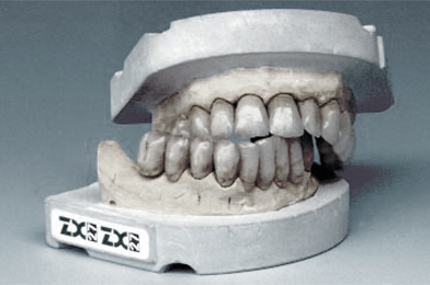 ZX-27 Attractive Glass Abutment System